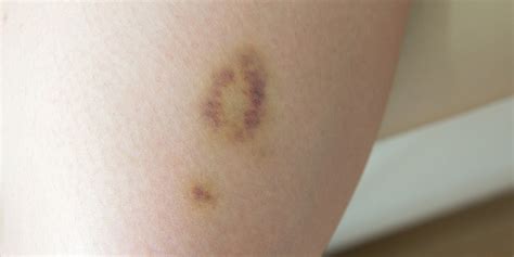 normal ive  bruising  acupuncture pt health