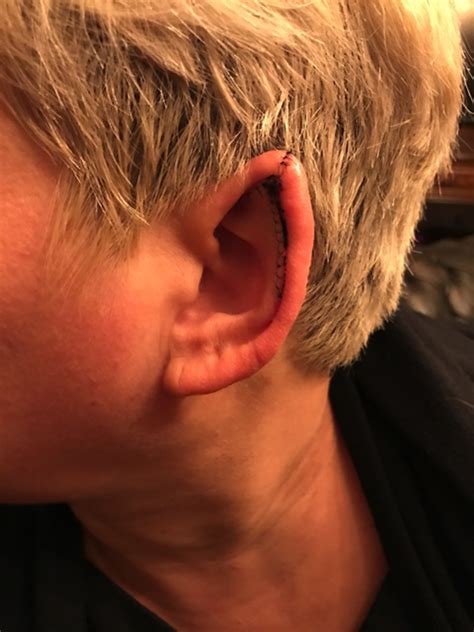 What it's really like getting 'elf ears' like Grimes wants
