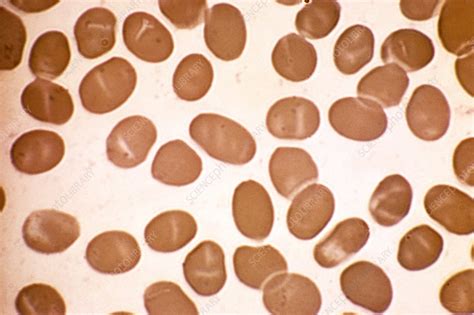 Elliptocytosis, light micrograph - Stock Image - C015/1792 - Science ...