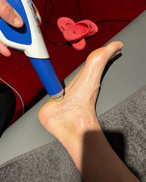 St - Physician heal thy self!! The great thing about shock wave therapy