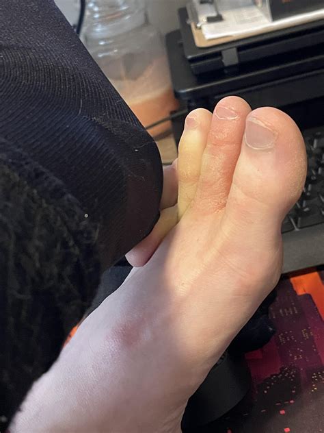 Terrorized my coworkers with my jointed toes (same on both feet) - Part