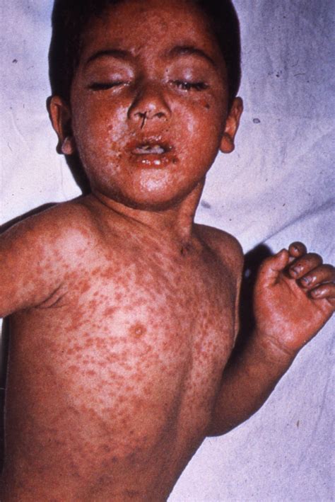 viral rashes child health