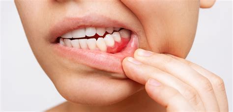 Periodontal Disease | The Dentist at 70 Pitt St