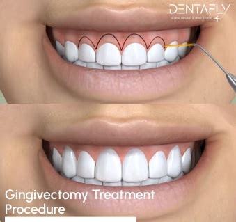 gingivectomy  complete guide  gingiva