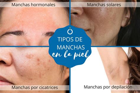 Tipos de MANCHAS en la PIEL y cómo tratarlas - ¡Con fotos!