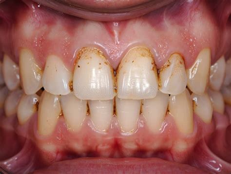 close   human teeth  plaque  gingivitis mouth dental stock