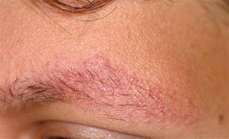 Keratosis pilaris