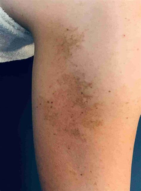 Pigmentation (Melasma) Are Dark Pigment Spots On The Face