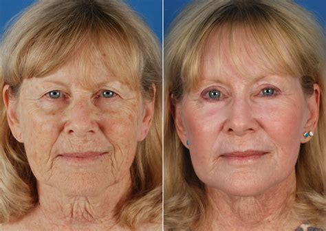 Laser Ablation On Face at Henry Hamill blog