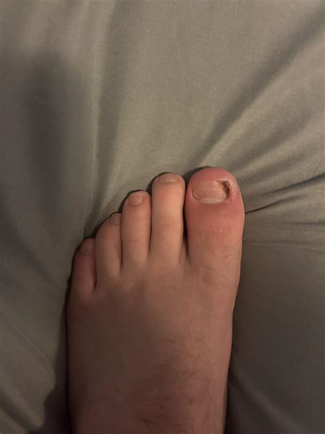 How do I treat this infected ingrown toenail? : r/medical