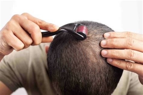 how often to use a derma roller for hair growth