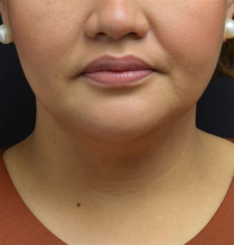 Chin - Sculpt MD