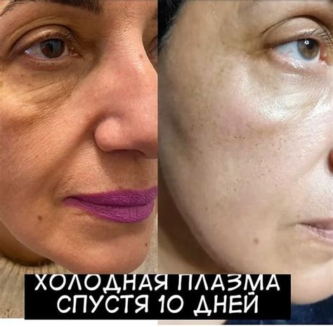 Холодная плазма