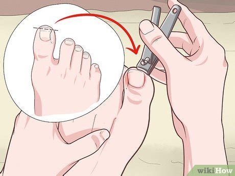 3 Ways to Cut an Ingrown Toenail - wikiHow Life