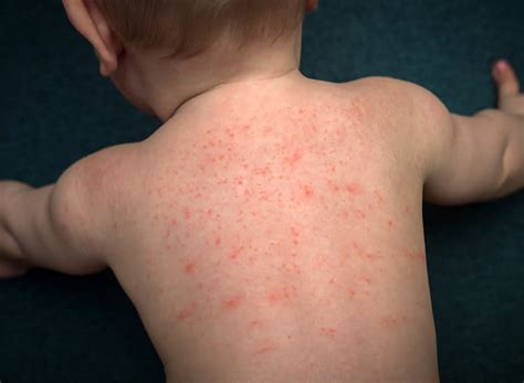 Baby Dry Skin Rash Eczema (Atopic Dermatitis) Condition, Treatments