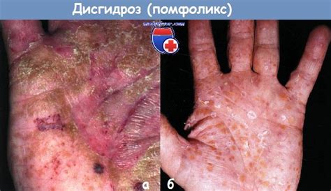 Дисгидроз (помфоликс) кистей рук и стоп