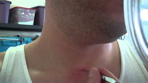 Pulling out an ingrown neck hair - YouTube