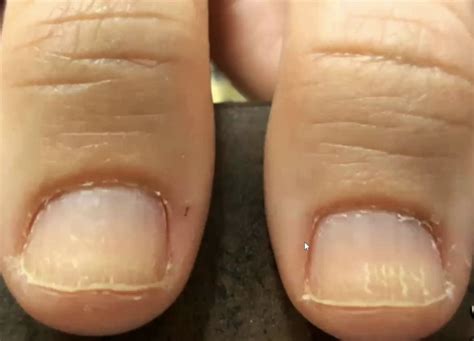 Symptoms Of Hypothyroidism Nails