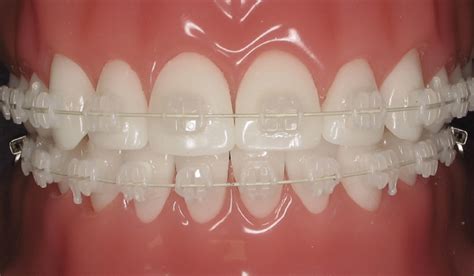 ceramic-braces