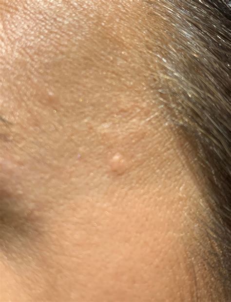 flesh coloured bumps  face rplusskincare