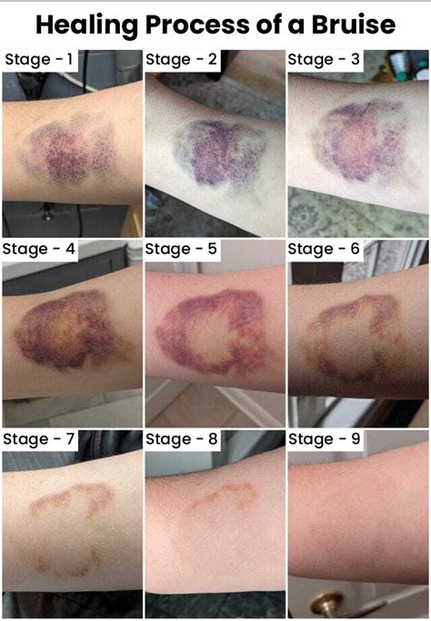 Bruise Healing