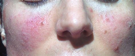 healthyself: MRSA versus Garlic the Allimed Challenge