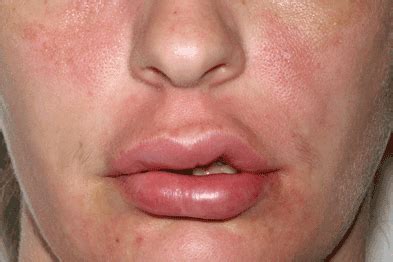 case study unexplained facial swelling gponline