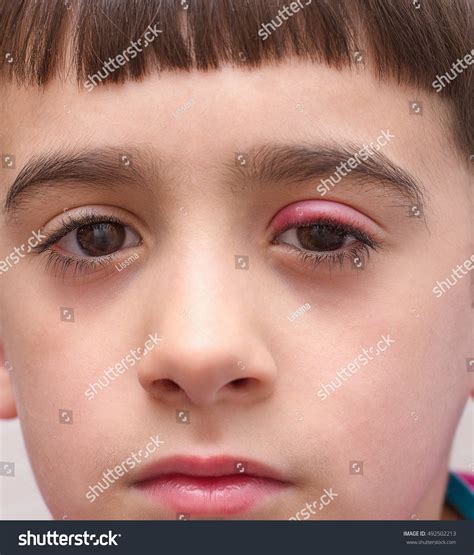 Stye Upper Eyelid Inflammation Stock Photo 492502213 | Shutterstock