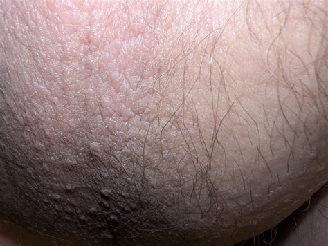 Small bumps just under base of scrotum? : r/DermatologyQuestions
