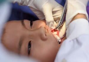 tooth extraction complete guide  procedure aftercare recovery