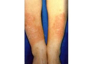 Pretibial myxedema
