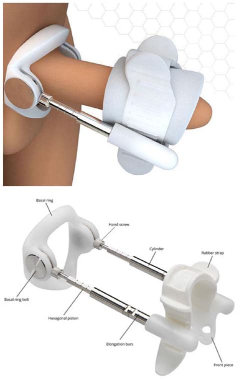 The use of penile traction therapy in the management of Peyronie's