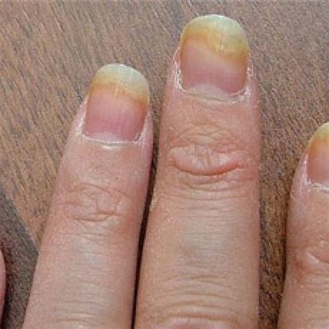 Best Nail Fungal Inhibitor & Repairing Agent for Damaged Nails