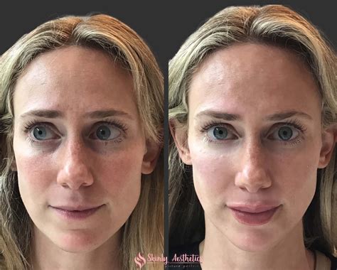 Botox Lips Before And After Thin Lips - Infoupdate.org