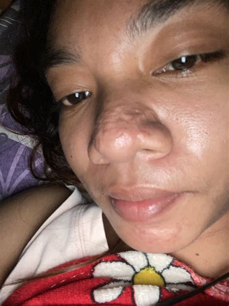 cara hilangkan bopeng bekas jerawat 14