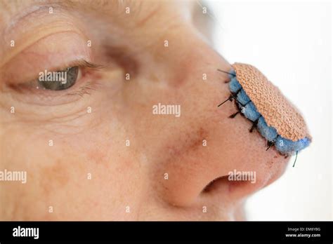 Skin graft after surgery Banque de photographies et d’images à haute ...