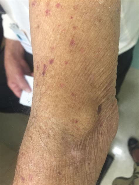 carcinoid tumor  skin