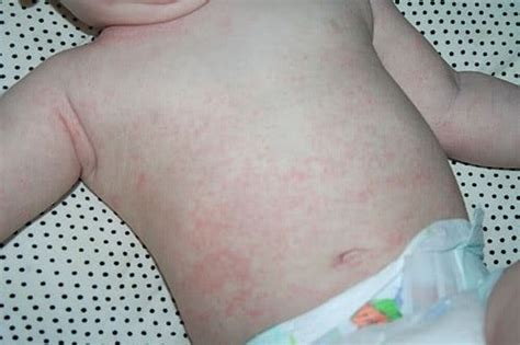 Кожная сыпь у детей опасна или сама пройдет?