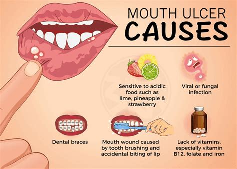 canker sores yoors