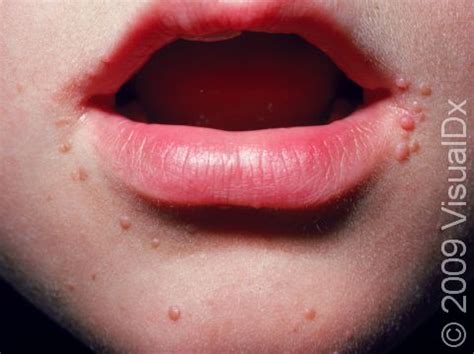 hpv bumps  mouth