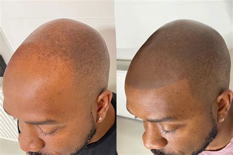 Scalp Micropigmentation Alopecia Areata & Totalis | BLADE SMP