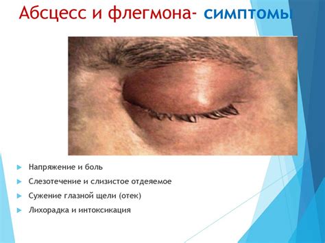 Заболевания век - презентация онлайн