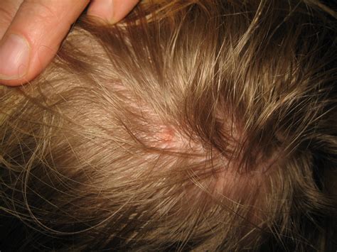 How to Get Rid of Lice | Insight Pest Solutions