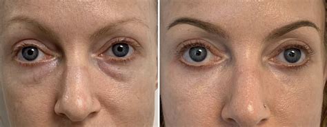 eye wrinkles laser