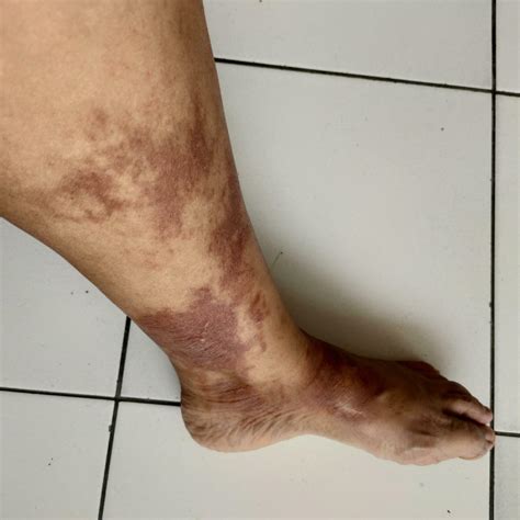 Horrible burns on left leg. Burns due to being scalded by hot water