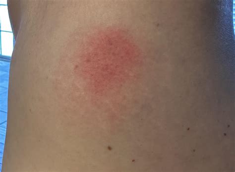 Posting for a friend- I say tick bite (lymes). What is your consensus