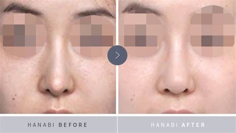 Nasal silicone implant removal surgery_01 - HANABI RHINOPLASTY CLINIC