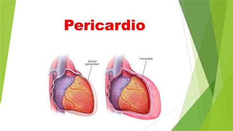 Pericardio | Pericardio | Medicina | uDocz