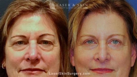 laser upper eyelid lift