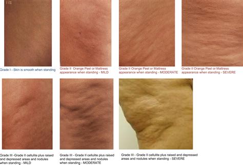 modern approach   treatment  cellulite dermatologic clinics